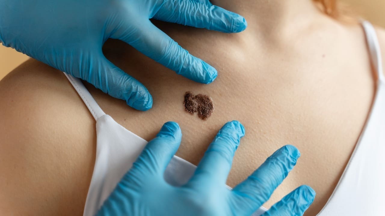 How Many People Have Skin Cancer? Facts, Rates, and Deaths Explained