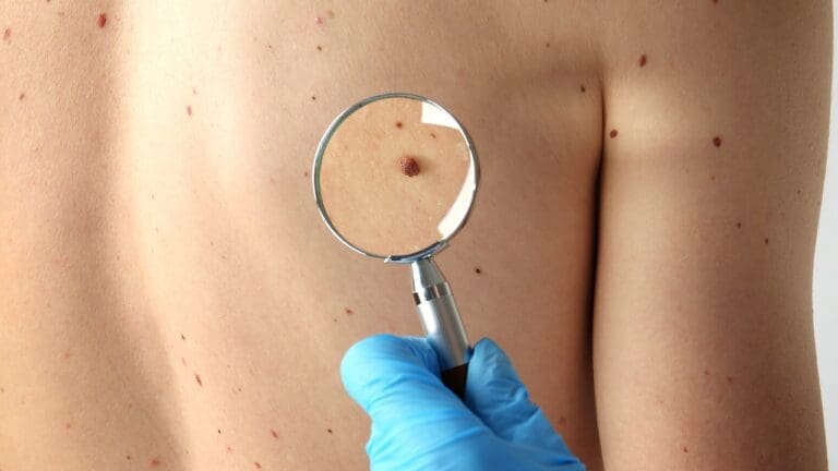 How Long Can You Survive With Untreated Skin Cancer or Melanoma?