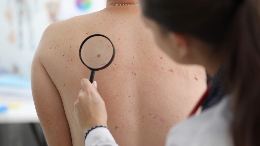 Early-Stage Melanoma