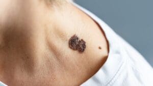 Is Skin Cancer Contagious or Infectious?