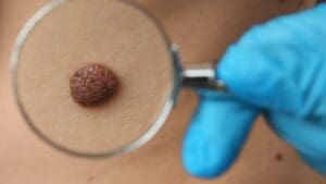 What Happens If Skin Cancer Goes Untreated? 7 Critical Risks You Must Know