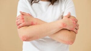 How Can Immunotherapy Cause Autoimmune Disease and What Are the Risks?