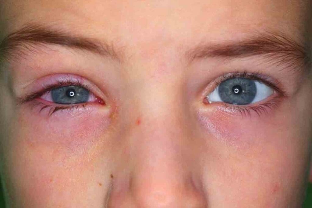 12 Key Symptoms of Eyelid Anemia & How Low Iron Triggers Palpitations