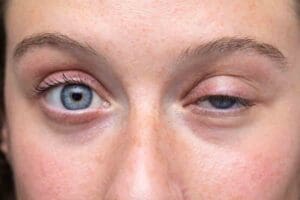 12 Key Symptoms of Eyelid Anemia & How Low Iron Triggers Palpitations