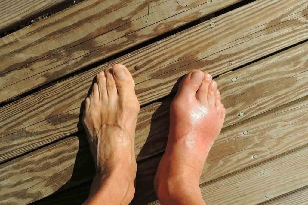 What Does a Blood Clot on Top of the Foot Look and Feel Like? (blood clot on top of foot pictures)

