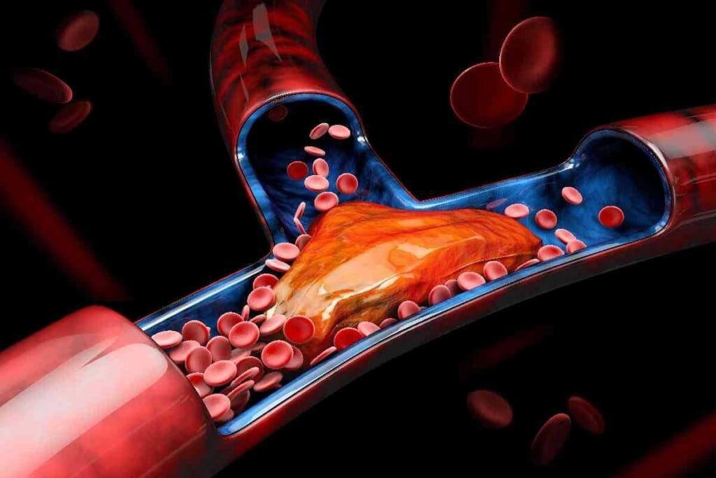What Causes Thrombosis and What Are the Main Risk Factors for Blood Clots? 3 What Causes Thrombosis and What Are the Main Risk Factors for Blood Clots?