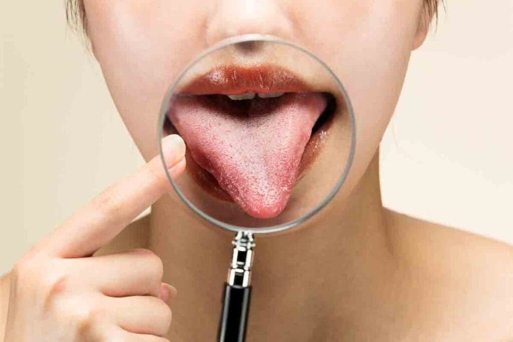 9 Key Signs of Pernicious Anemia Tongue: Pictures, Glossitis, and More 3 9 Key Signs of Pernicious Anemia Tongue: Pictures, Glossitis, and More
