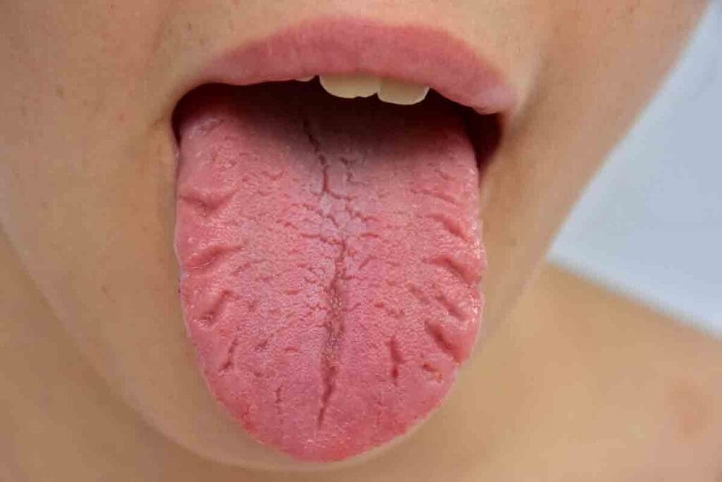 Anemia Tongue Symptoms: 7 Key Signs and Practical Remedies 1 Anemia Tongue Symptoms: 7 Key Signs and Practical Remedies