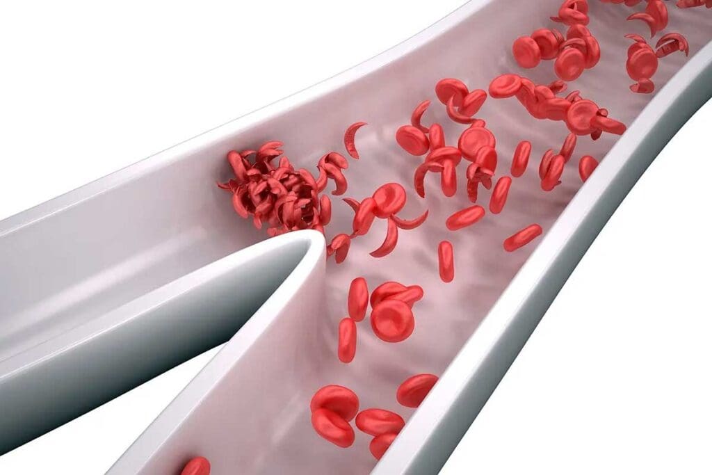 What Is a Thrombus? Understanding Blood Clots, Thrombi, and Vessel Obstruction