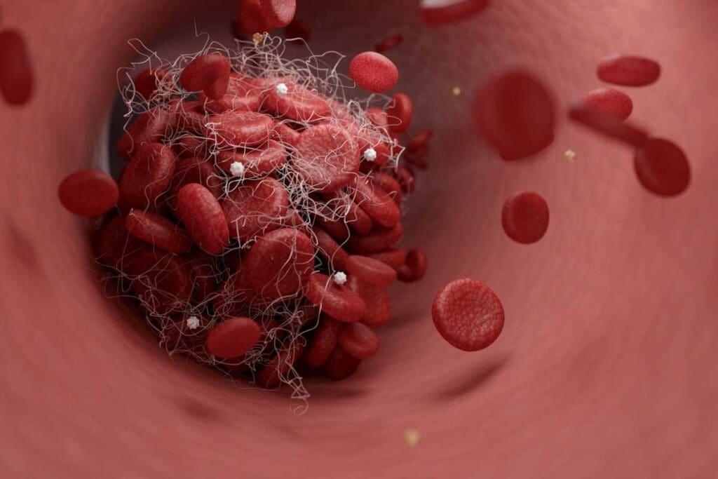 Define Thrombosis: 7 Key Facts About Blood Clots Blocking Vessels
