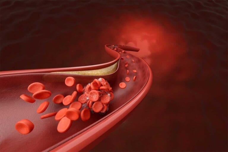 What Is Thrombosis? Thrombosis Meaning, Causes, Symptoms, and Key Definitions