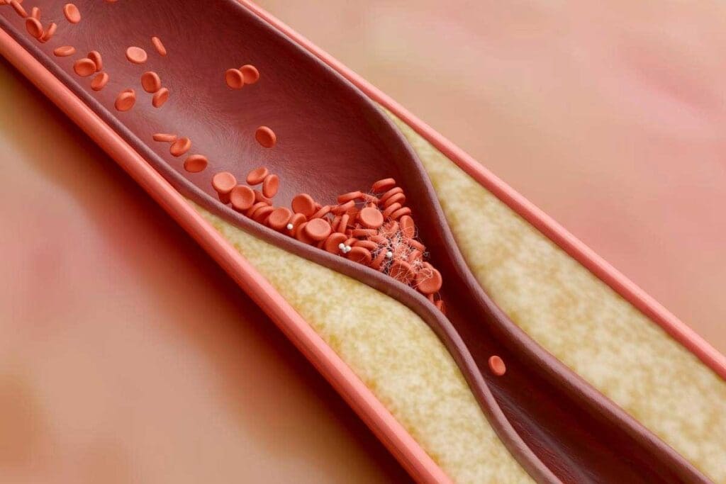 What Is Thrombosis? Meaning, Causes, Symptoms, and Key Definitions