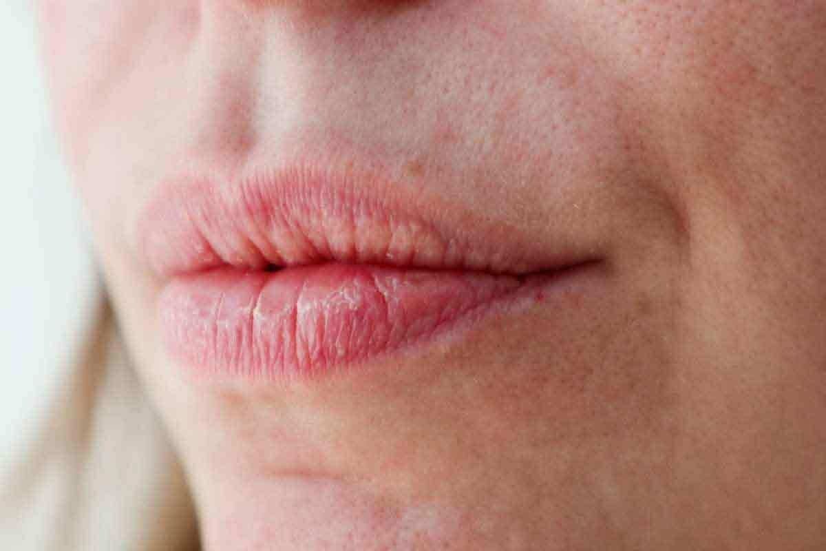 Why Do Lips Turn Pale: Understanding Anemia Lips?