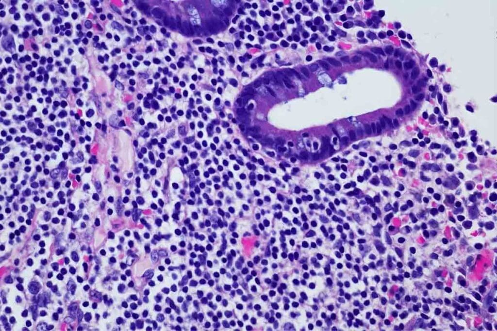 5 Critical Things to Know About Acute Leukemia for Faster Care