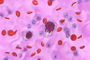 5 Critical Things to Know About Acute Leukemia for Faster Care