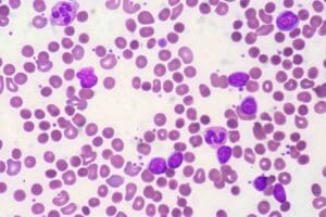 What Is Acute Lymphocytic Leukemia (ALL) and How Does It Differ From Other Leukemias?