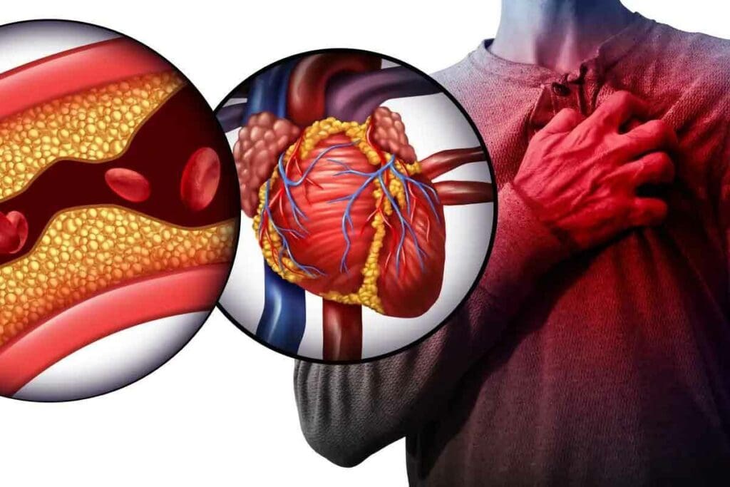 What Is Acute Coronary Artery Thrombus and How Does It Cause Heart Attacks? 2 What Is Acute Coronary Artery Thrombus and How Does It Cause Heart Attacks?
