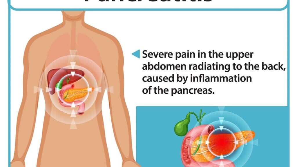 What Is Diffuse Large B-Cell Lymphoma (DLBCL) and How Does It Affect the Body? 3 image 2601 LIV Hospital