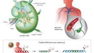 What Is Diffuse Large B-Cell Lymphoma (DLBCL) and How Does It Affect the Body?