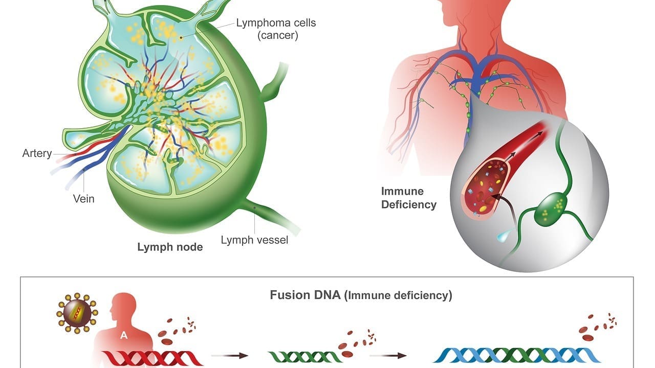 What Is Diffuse Large B-Cell Lymphoma (DLBCL) and How Does It Affect the Body?