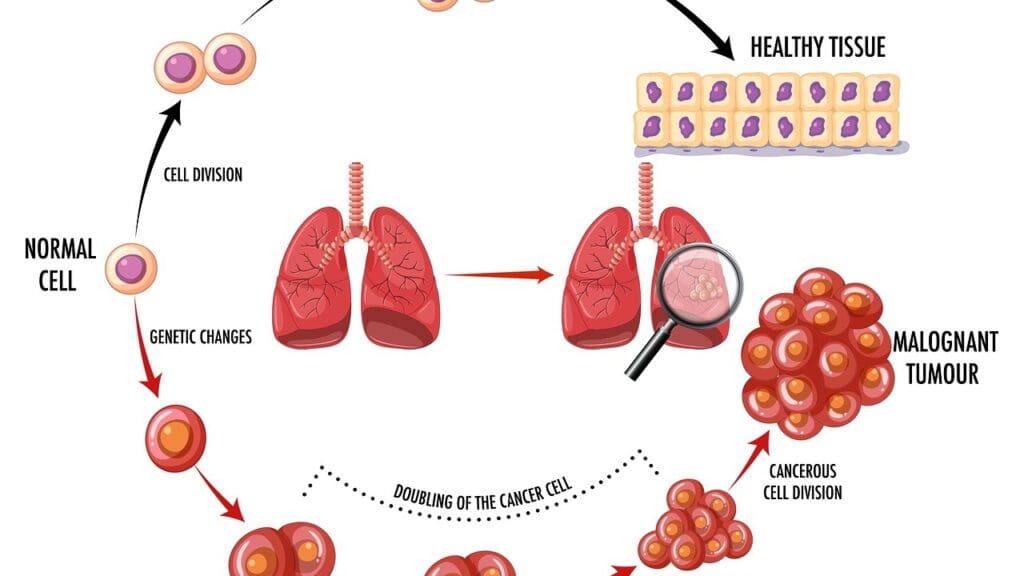What Is Diffuse Large B-Cell Lymphoma (DLBCL) and How Does It Affect the Body? 2 image 2583 LIV Hospital