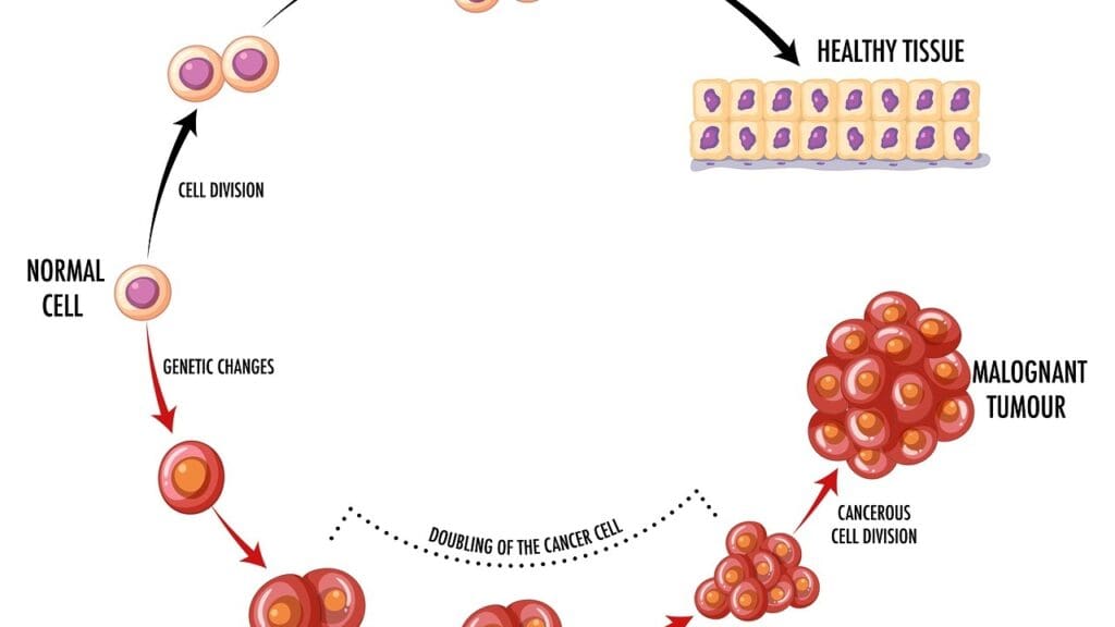 B Cell Lymphoma Types: 12 Key Categories and Their Distinct Features 2 image 2542 LIV Hospital