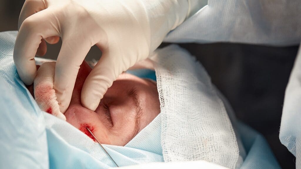 Basal Cell Carcinoma on the Nose with Mohs Surgery