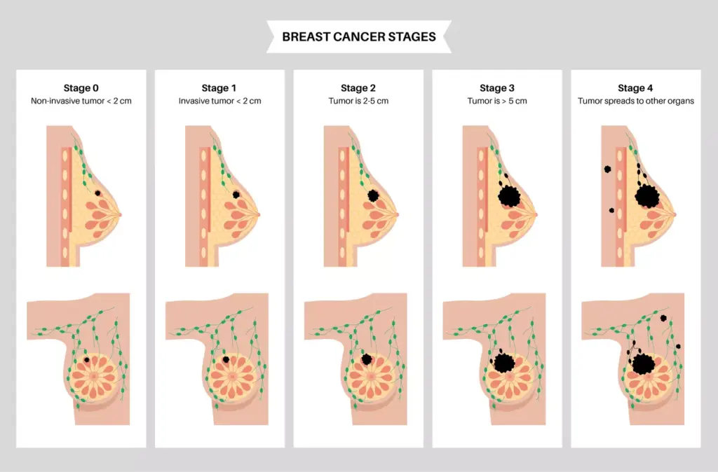 Breast Cancer: Types and Stages