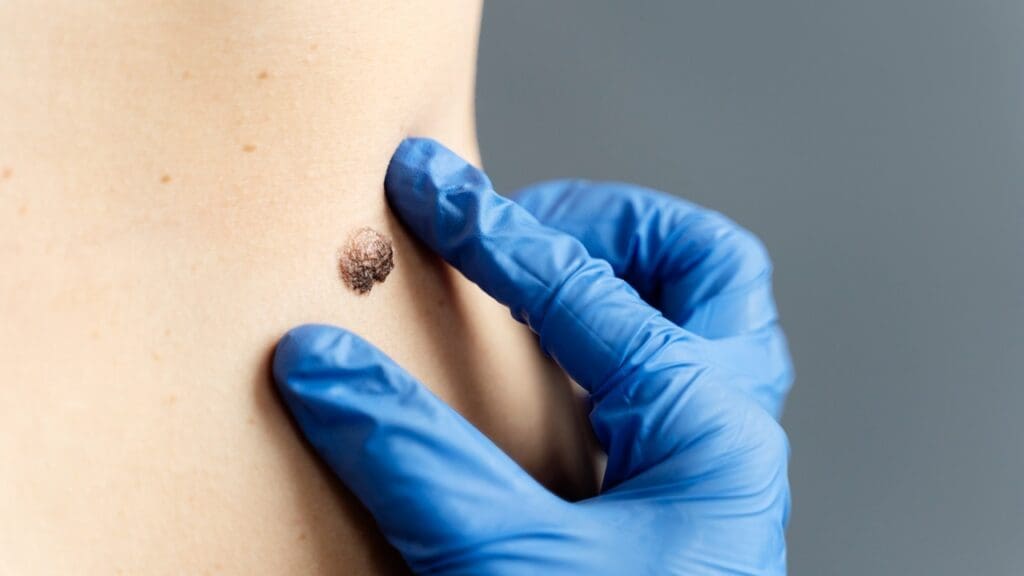 Remove Basal Cell Carcinoma Remove Basal Cell Carcinoma