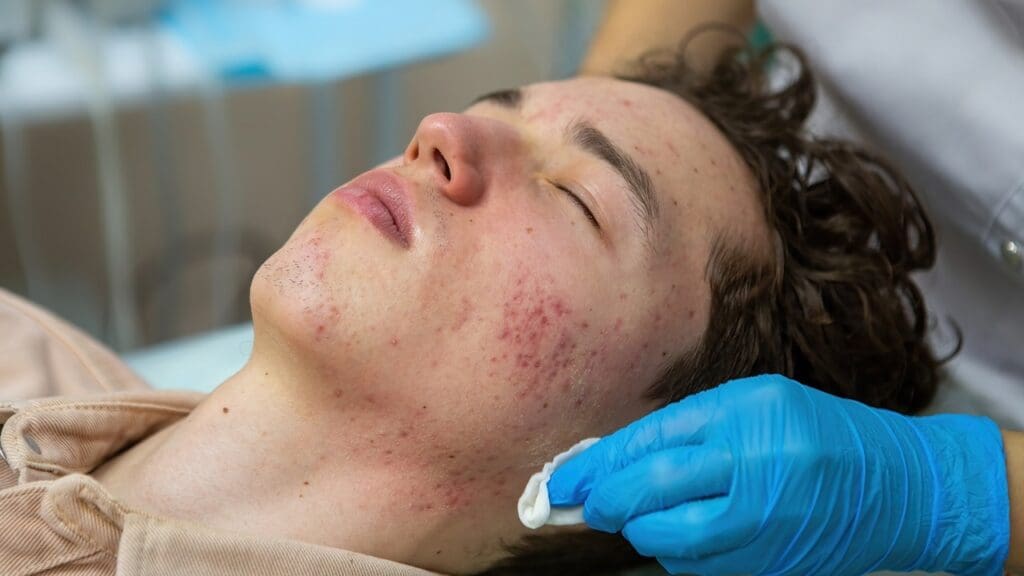Remove Basal Cell Carcinoma Remove Basal Cell Carcinoma
