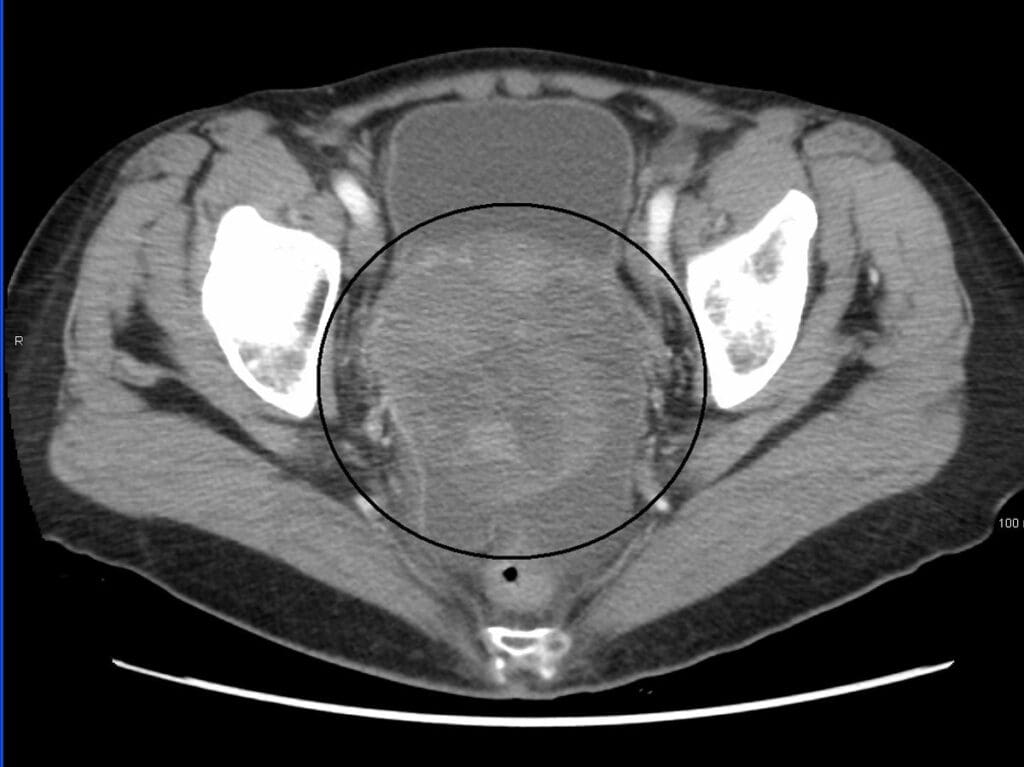 Yes: Does a CT Scan Detect Tumors in the Bladder?