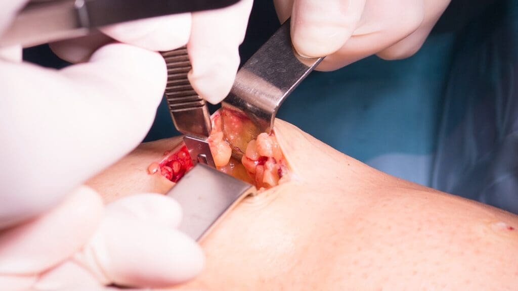 Mohs Surgery for Basal Cell Carcinoma