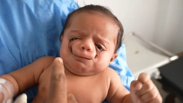 Understanding Fetal Alcohol Syndrome: The Alarming Leading Cause of Birth Defects