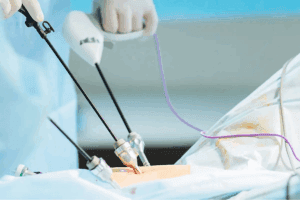 Colectomy Recovery: How Long After Resection Surgery?