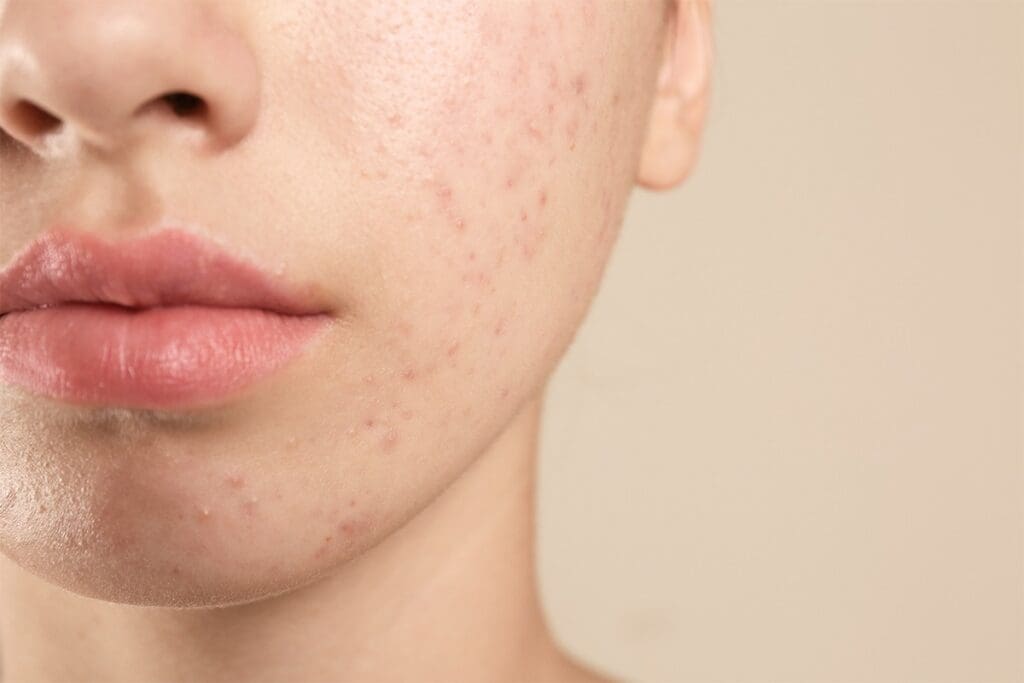 Dermatologist About Acne: An Essential Teen Guide