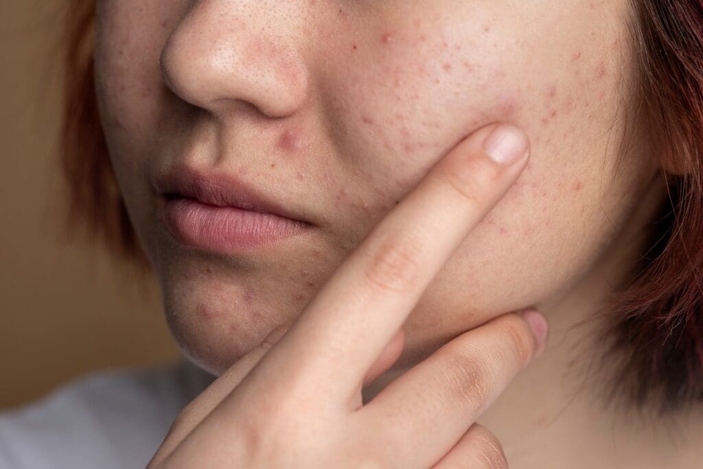 Dermatologist About Acne: An Essential Teen Guide