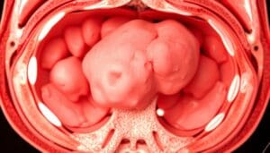 7 Key Facts About Tumor Adrenocortical: Stages, Metastasis, and Treatment