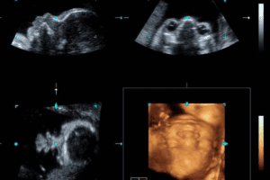 Causes of Genetic Disorders : Fetal Genetic  Abnormalities