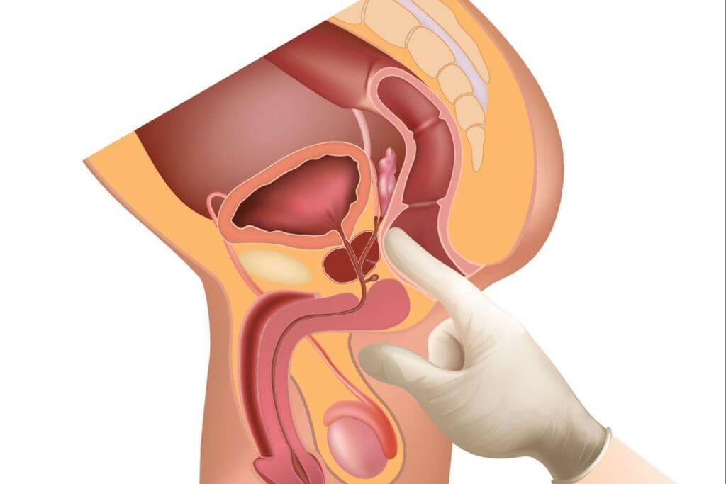 Is Prostate Biopsy Painful? | What to Expect 2 Is Prostate Biopsy Painful? | What to Expect