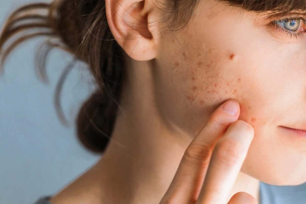 How to Get Rid of Acne: Proven Secrets for Success