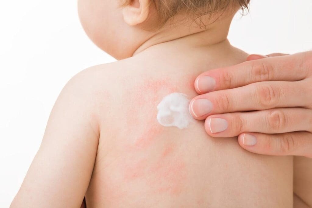 Baby Eczema: 10 Expert-Approved Ways to Protect and Soothe Skin