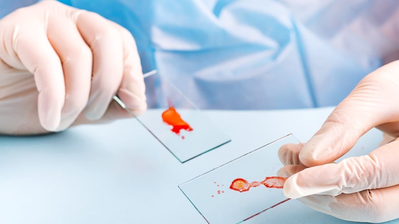 What Is the Prognosis for Acute Myeloid Leukemia and Can It Be Cured?