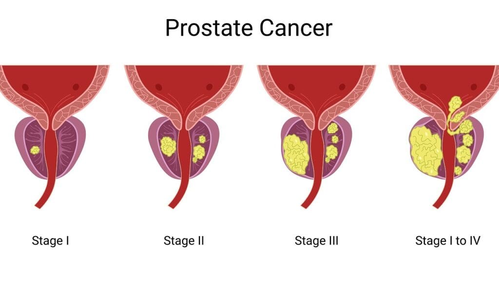 prostate cancer growth rate comparison
