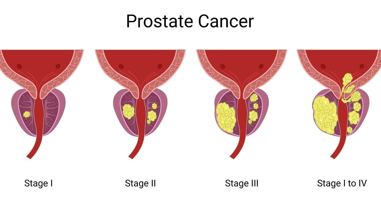 How Fast Does Aggressive Prostate Cancer Grow and Spread?