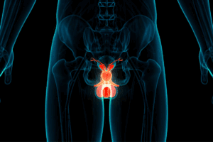 Robotic Prostate Surgery – How to Prep Your Bowels Before Operation