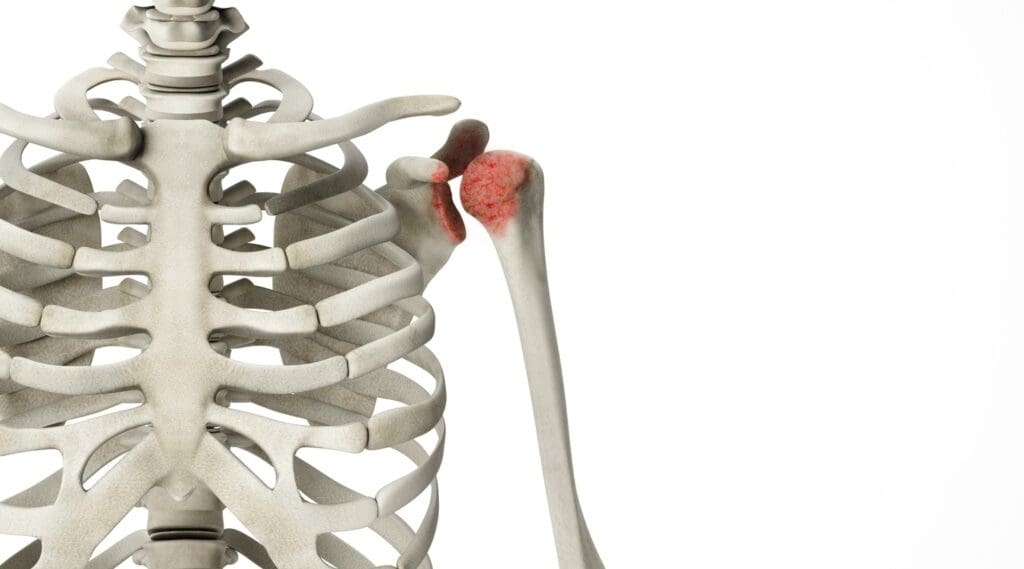 A detailed cross-section of bone metastasis