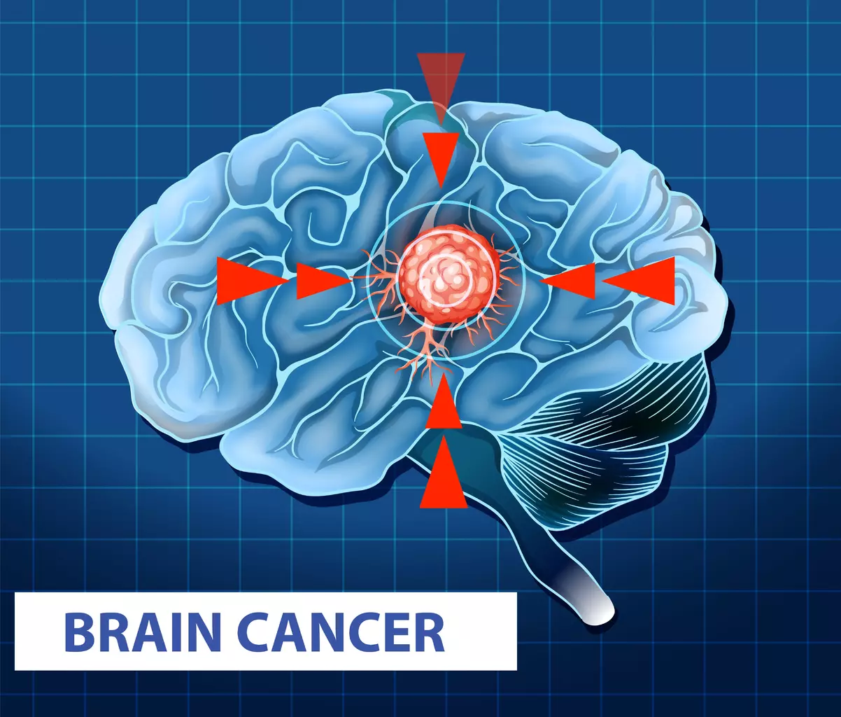Can Brain Tumors Be Cured, and What Are the Survival Rates?