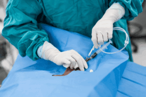 Catheter – What Happens If You Ejaculate While Wearing It