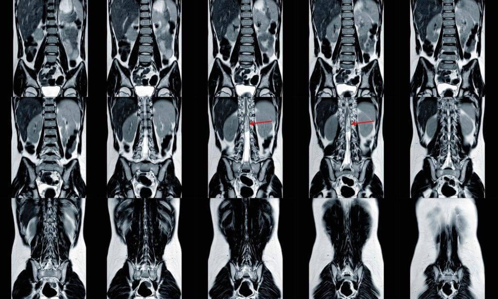 A detailed x-ray image of metastatic bone cancer, showing multiple lesions and osteolytic destruction throughout the skeletal structure A detailed x-ray image of metastatic bone cancer, showing multiple lesions and osteolytic destruction throughout the skeletal structure