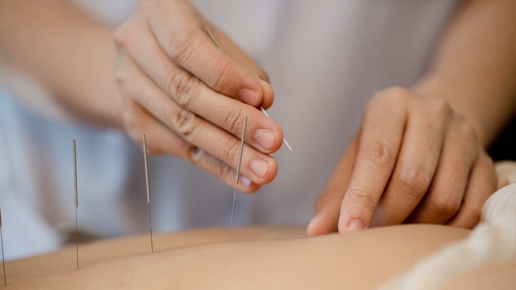 acupuncture